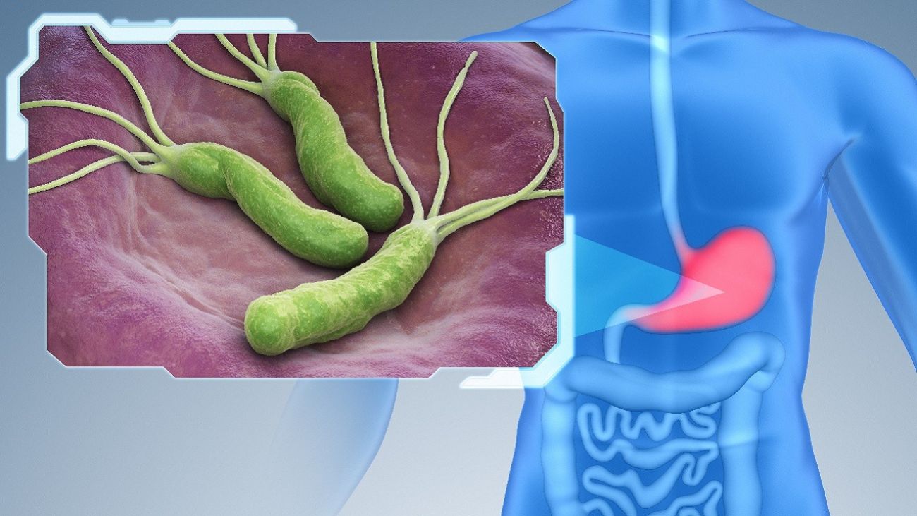 Kaskadenmagen; Bakterium Helicobacter pylori