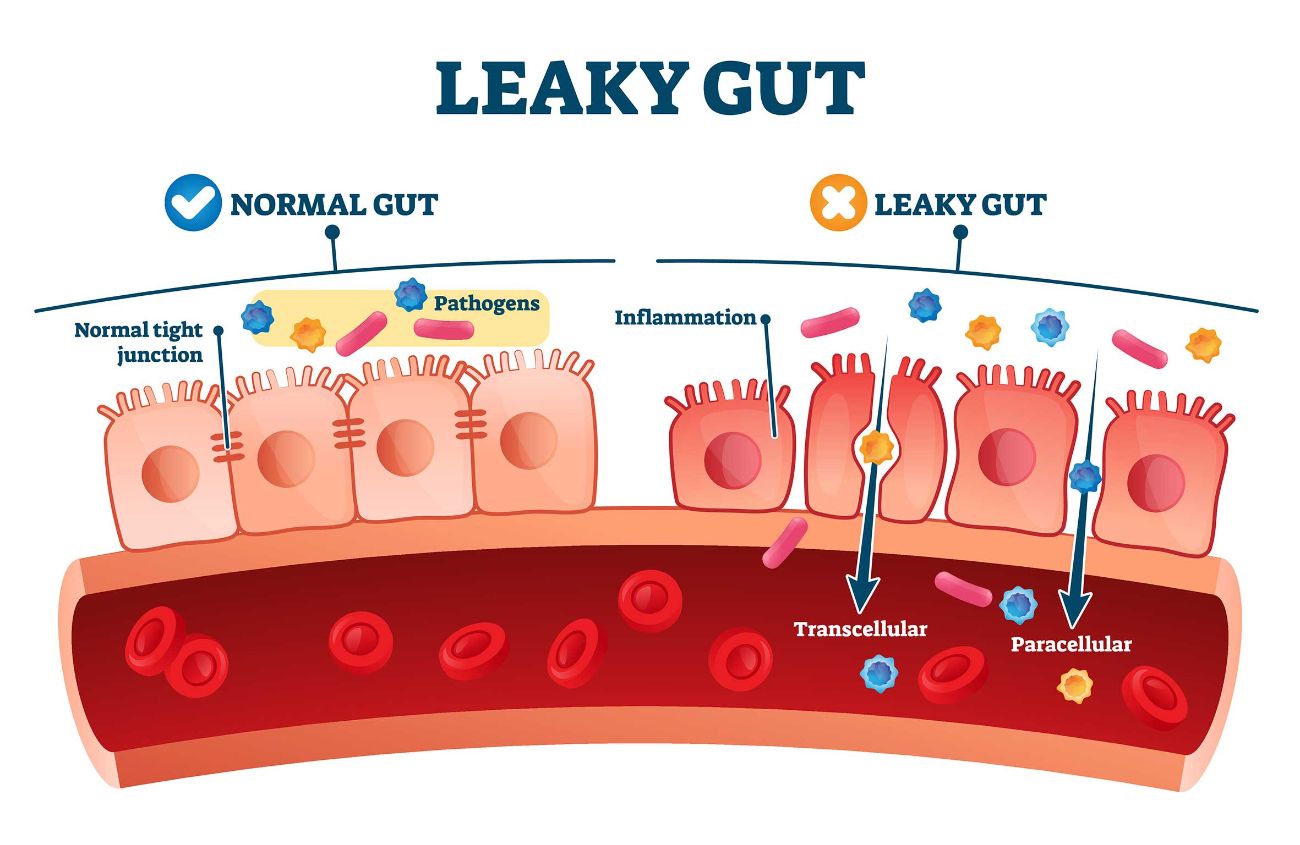 Vergleich zwischen einem normalen Darm und einem Darm mit Leaky-Gut-Syndrom