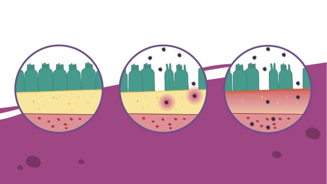 Leaky-Gut-Syndrom, Schadstoffe gelangen durch die Darmbarriere in die Blutbahn